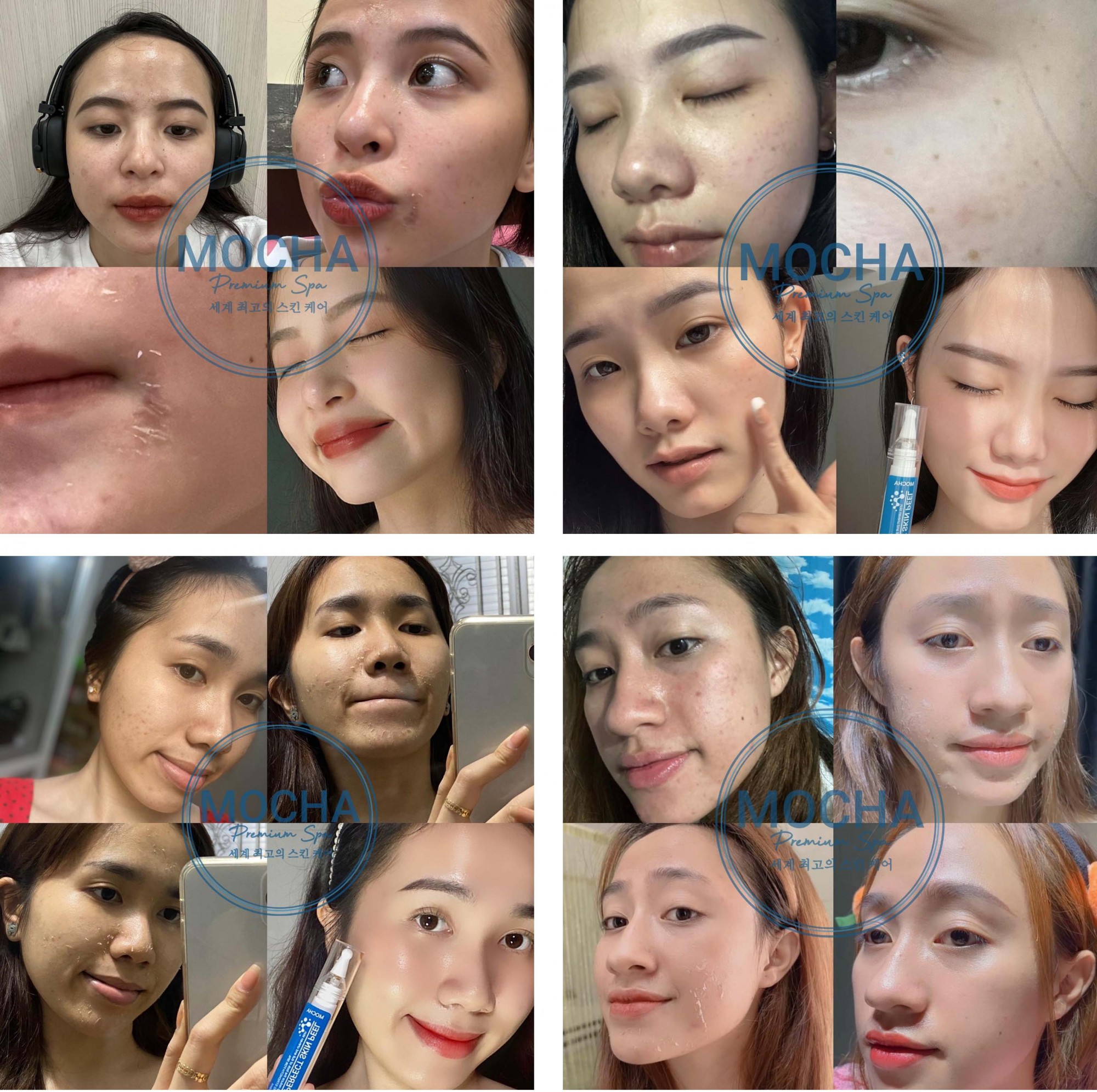 kết quả dùng retinol mix peel